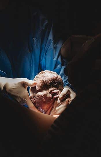 A baby is delivered via a vaginal birth.