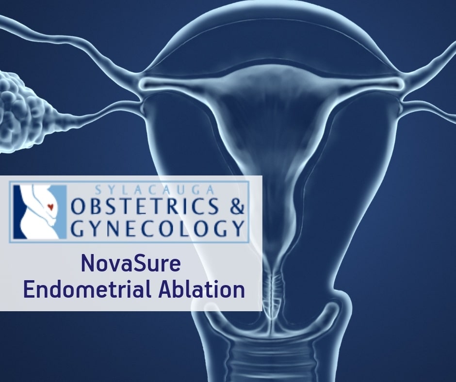 Sylacauga OBGYN offers NovaSure Endometrial Ablation procedures.