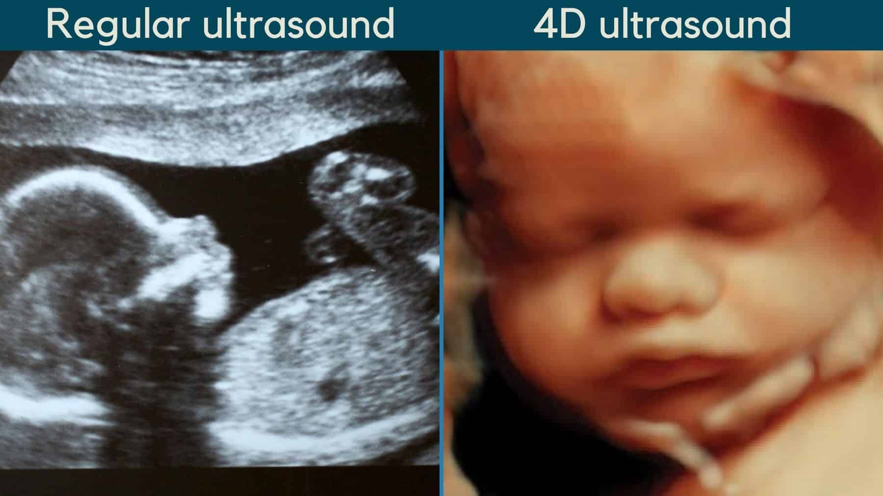Baby in 4D Ultrasound